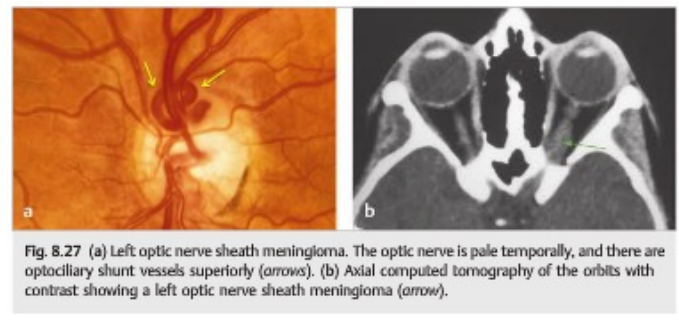 <p><strong>Tumors </strong>- Typically presenting <strong>unilaterally</strong></p><p><strong>Grave’s disease</strong></p><p><strong>Aneurysms</strong></p>
