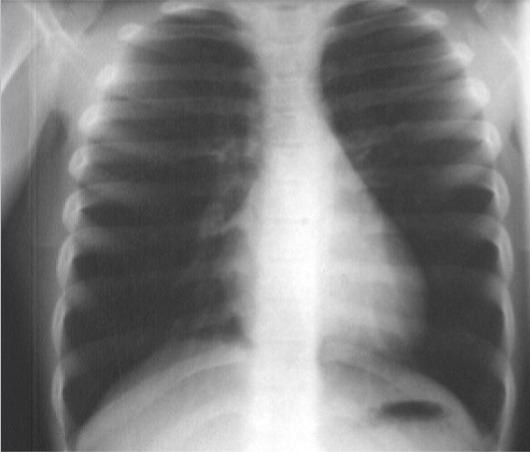 <p>Asthma: CXR</p>