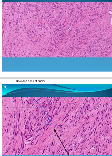 <p>UTERUS:</p><p>Leiomyoma of endometrium = acute mesenchymal tumor, rising up from smooth muscle.</p><ul><li><p>Pseudocapsule of tumoral growth due to compression</p></li><li><p>Styrofoam aspect of smooth muscle with nuclei which are elongated with rounded ends</p></li><li><p>Hyaline tissue</p></li></ul>