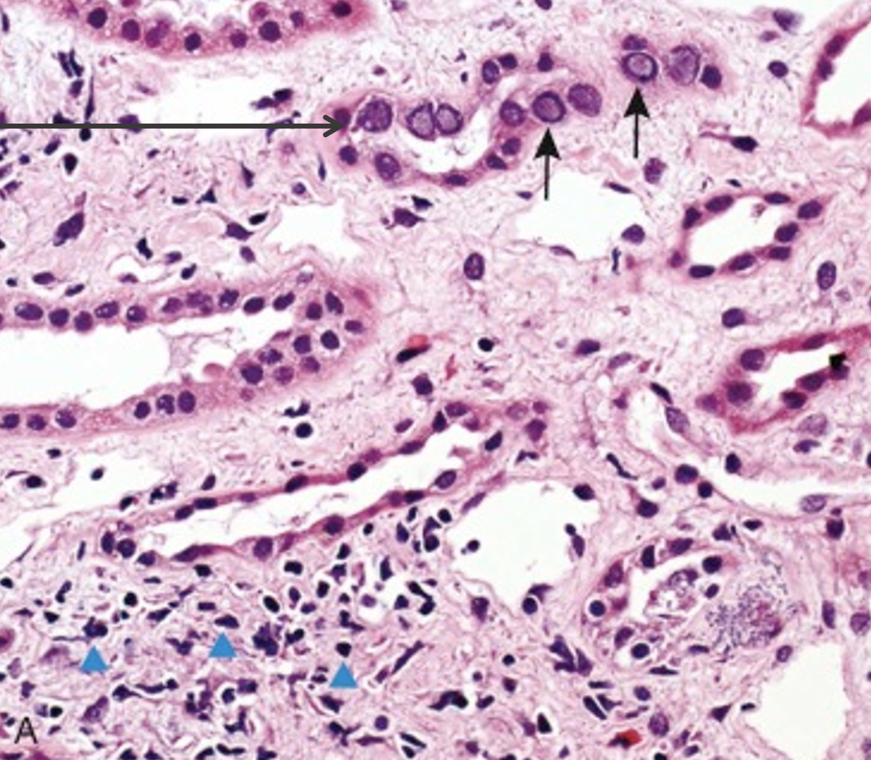 <p>This image indicates Polyoma virus at the black arrows…..what clinical diagnosis would this indicate? What is found at the blue triangles?</p>