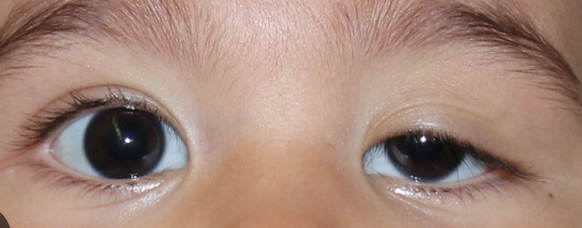 <p>Abnormal findings of <strong><em>2. Inspect Eyelids &amp; Eyelashes</em></strong></p><ul><li><p>Drooping of the upper lid</p></li><li><p>Attributed to oculomotor nerve damage, myasthenia gravis, weakened muscle or tissue, or a congenital disorder</p></li></ul><p></p>