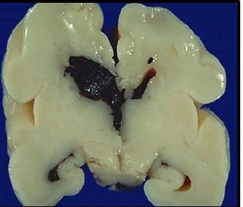 <p>what makes babies more susceptible to intraventricular hemorrhage?</p>