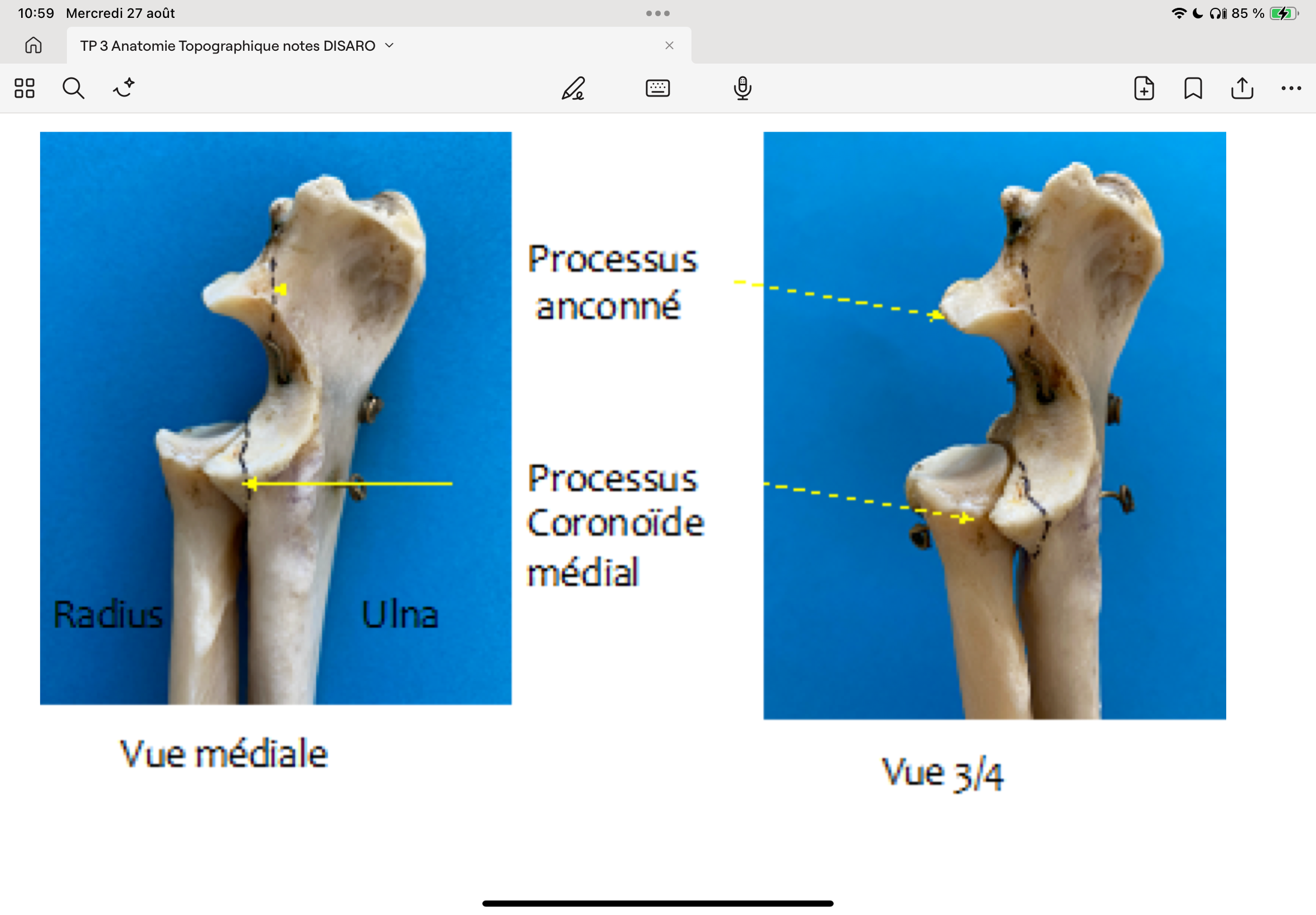 <p>FPCI (Fragmentation du Processus coronoïde interne) lors de croissance trop rapide de l’ulna par rapport au radius = Ulna trop long. Le poids du corps est supporté par le processus coronoide interne (ou médial) articulé avec le condyle médial de l’humérus. Celui-ci se fracture alors et le fragment osseux gêne les mouvements (+ douleur).</p><ul><li><p>OCD, mal articulation (voir cours de chirurgie de M Balligand en GMV1)</p><p>Diagnostic : pour voir toutes les structures, il est nécessaire de faire au moins deux radios : une vue latérale et une crâniale.</p></li></ul>