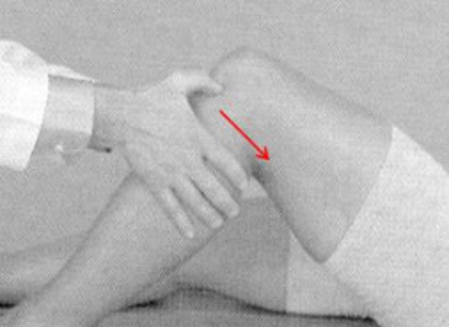 <p>What is a (+) posterior drawer?</p>