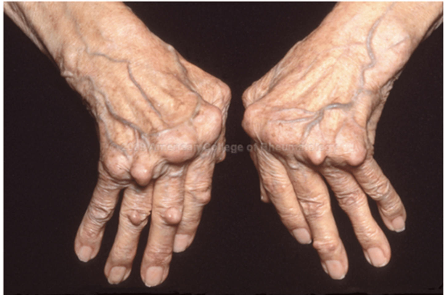 <p>Usually symmetrical and polyarticular</p><p>Joint pain and stiffness</p><p>Subluxation of joints &amp;</p><p>spindle-shaped appearance</p><p>Progressive joint destruction</p><p>-- Misalignment of bone</p><p>-- Swelling and thickening</p><p>-- Limitation of movement</p>