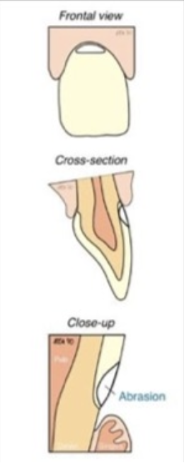 <p>What is abrasion?</p>