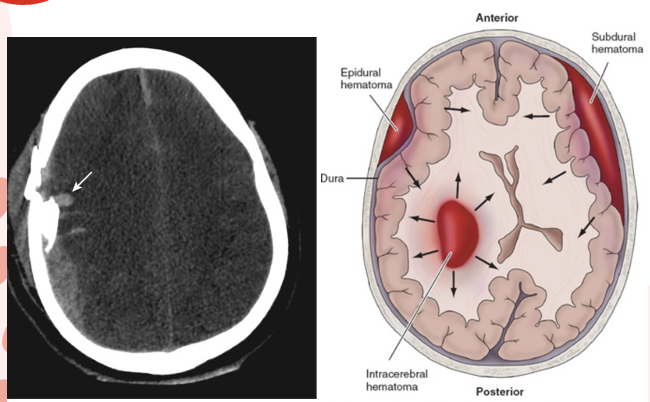 <p>Are isolated injuries to small parts…(specific area)</p><ul><li><p><strong><u>Contusion</u></strong>: brain is bruised and damaged d/t impact of brain against skull.</p><ul><li><p><strong>S/sx vary on size, location, and extent of cerebral edema</strong>:</p><ul><li><p>Loss of consciousness + stupor and confusion</p></li><li><p>Hemorrhage &amp; edema (peak at 18-36 hrs) → increased ICP &amp; possible herniation</p></li></ul></li><li><p><strong>Coup and Contrecoup</strong></p><ul><li><p><em>coup</em> = actual impact</p></li><li><p><em>countercoup</em> = the brain hitting the skull (the rebound)</p></li></ul></li></ul></li><li><p><strong><u>Hematoma</u></strong>: collection/pooling of blood in brain may be:</p><ul><li><p>Symptoms can be delayed until damage is significant but even small, rapidly developing hematomas can be fatal.</p></li></ul></li></ul><p>Image—(R) Contusion (L) Hematoma</p>