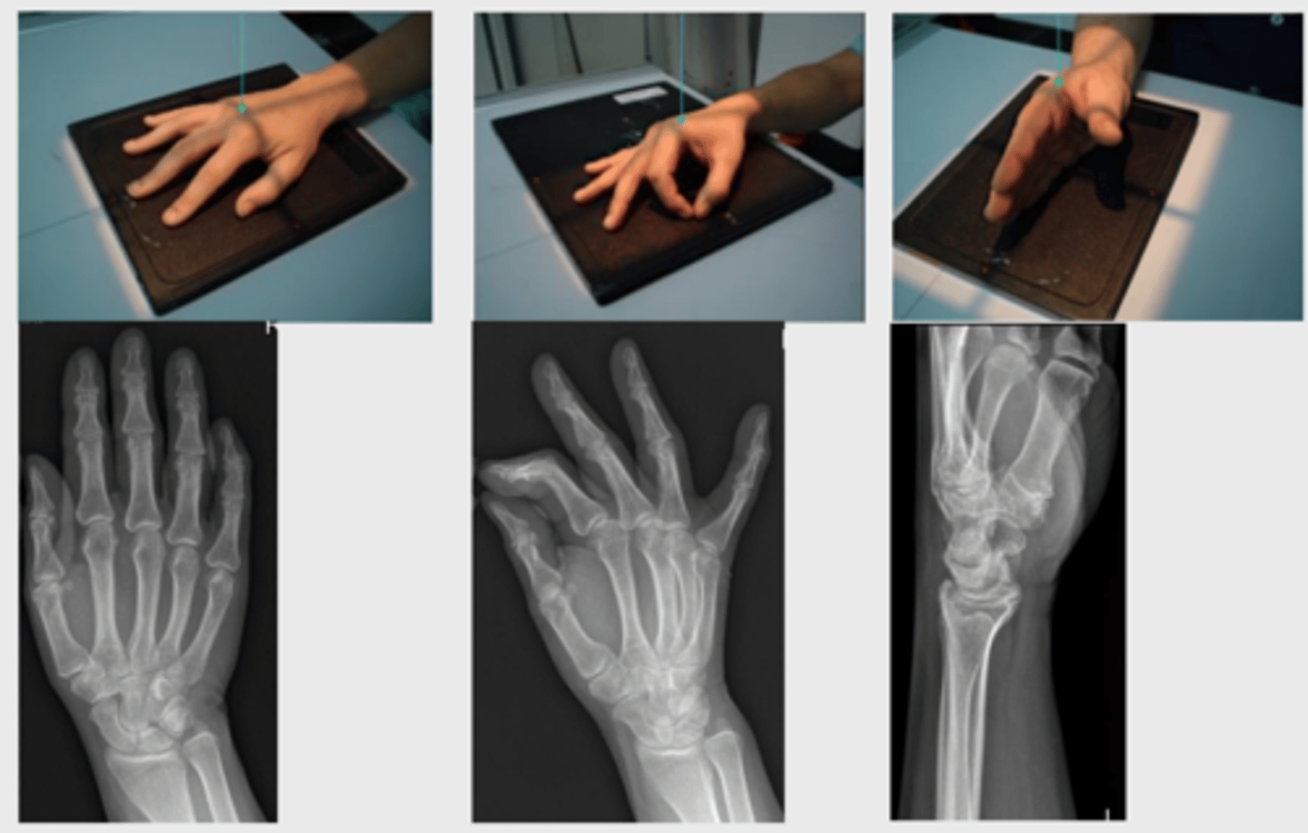 <p>The hand is studied with AP (anteroposterior) and oblique projections to individually appreciate the different bone and joint elements.</p>