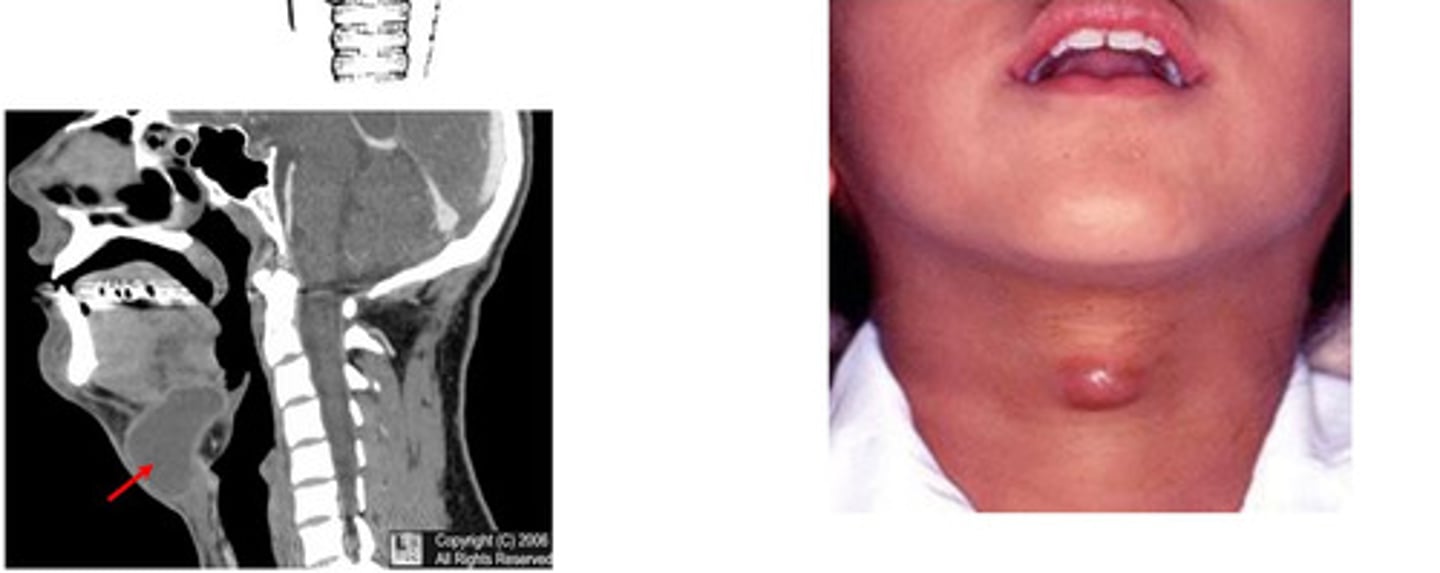 <p>thyroglossal duct from thyroid development can remain in the anterior neck &amp; become infected==&gt; presents as painless swelling in the midline near hyoid bone that moves when swallowing <br><br>*Tx= Sistrunk Procedure --&gt; surgical resection of the duct to base of tongue &amp; the hyoid bone to ensure complete removal of the duct</p>