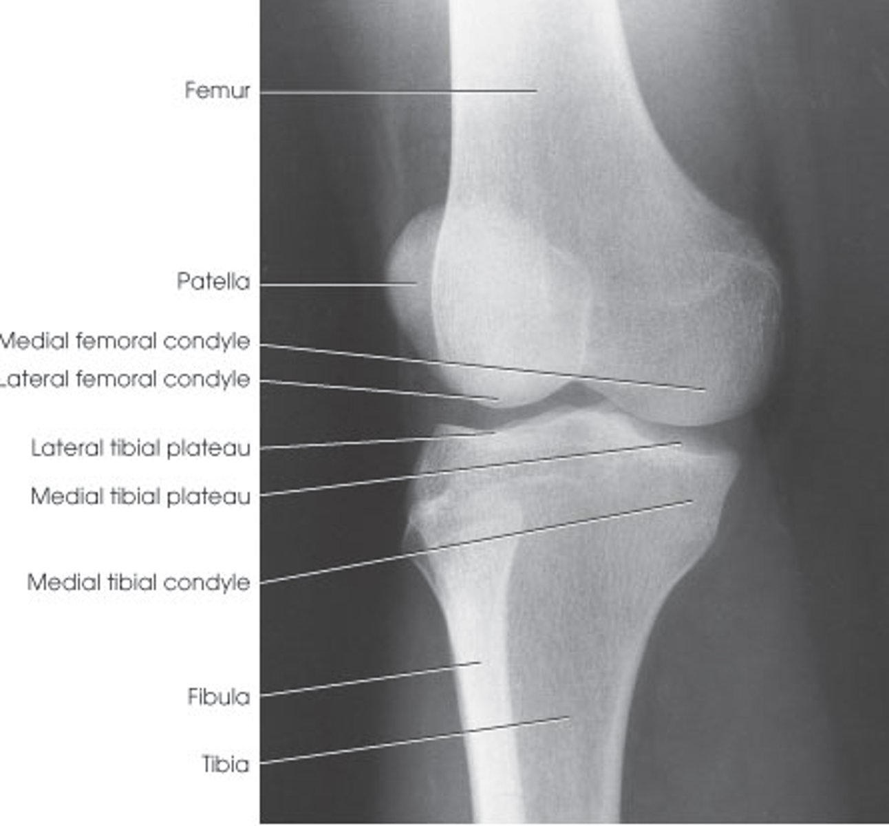 <p>proximal fibula superimposed by the proximal tibia</p><p>medial condyles of the femur and tibia seen in profile</p><p>half of patella should be free of superimposition by the femur</p>