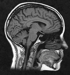 <ul><li><p>a technique that uses magnetic fields and radio waves to produce computer-generated images of soft tissue</p></li><li><p>shows brain anatomy</p></li></ul><p></p>