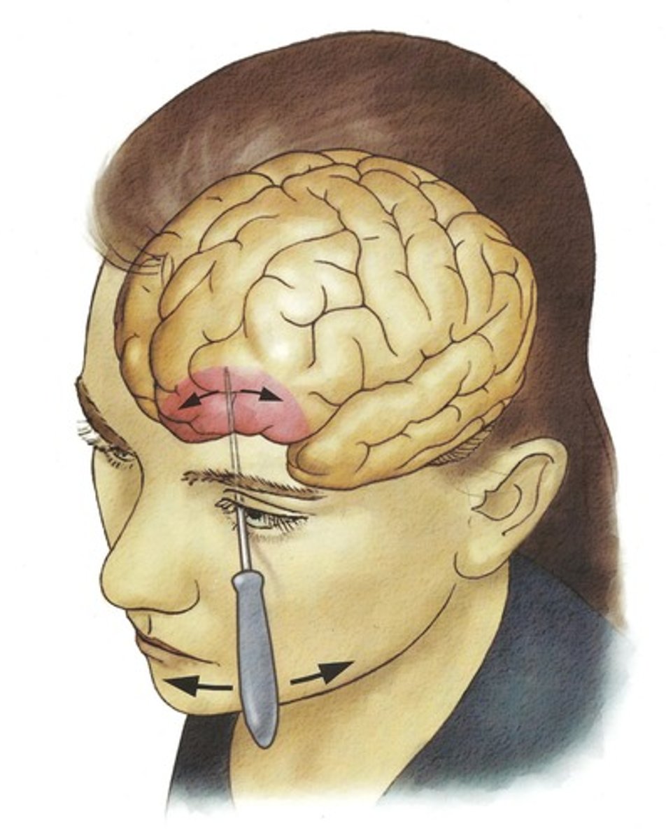 <p>damages small areas of white matter behind each frontal lobe with intention of decreasing pathological levels of agitation/emotional arousal</p>