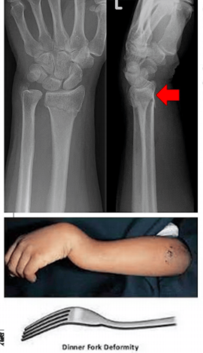 <p>Extra-articular fracture of the distal radius</p><p>Dorsal angulation & dorsal displacement - dinner fork deformity </p><p>Caused by FOOSH to the FRONT of the hand </p>
