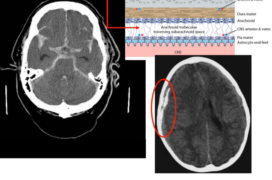 <p>_____ ______ is indicated by blood filling up in the sulci </p>