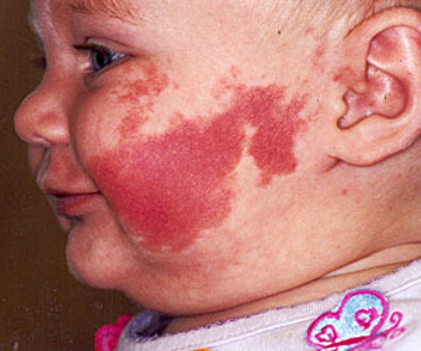 <p>A congenital skin condition that can affect any part of the body and PERSISTS through life (does not disappear).</p>