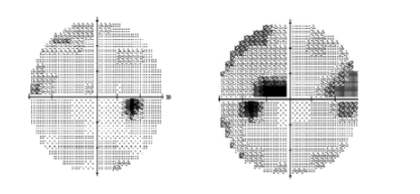 <p>describe the location of this lesion &amp; the most probable cause</p>