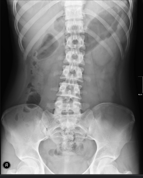 <p>including the kidneys, ureter, and bladder (KUB), is obtained with the patient lying supine and is used to identify intestinal obstruction and other organ-specific structural abnormalities.</p>