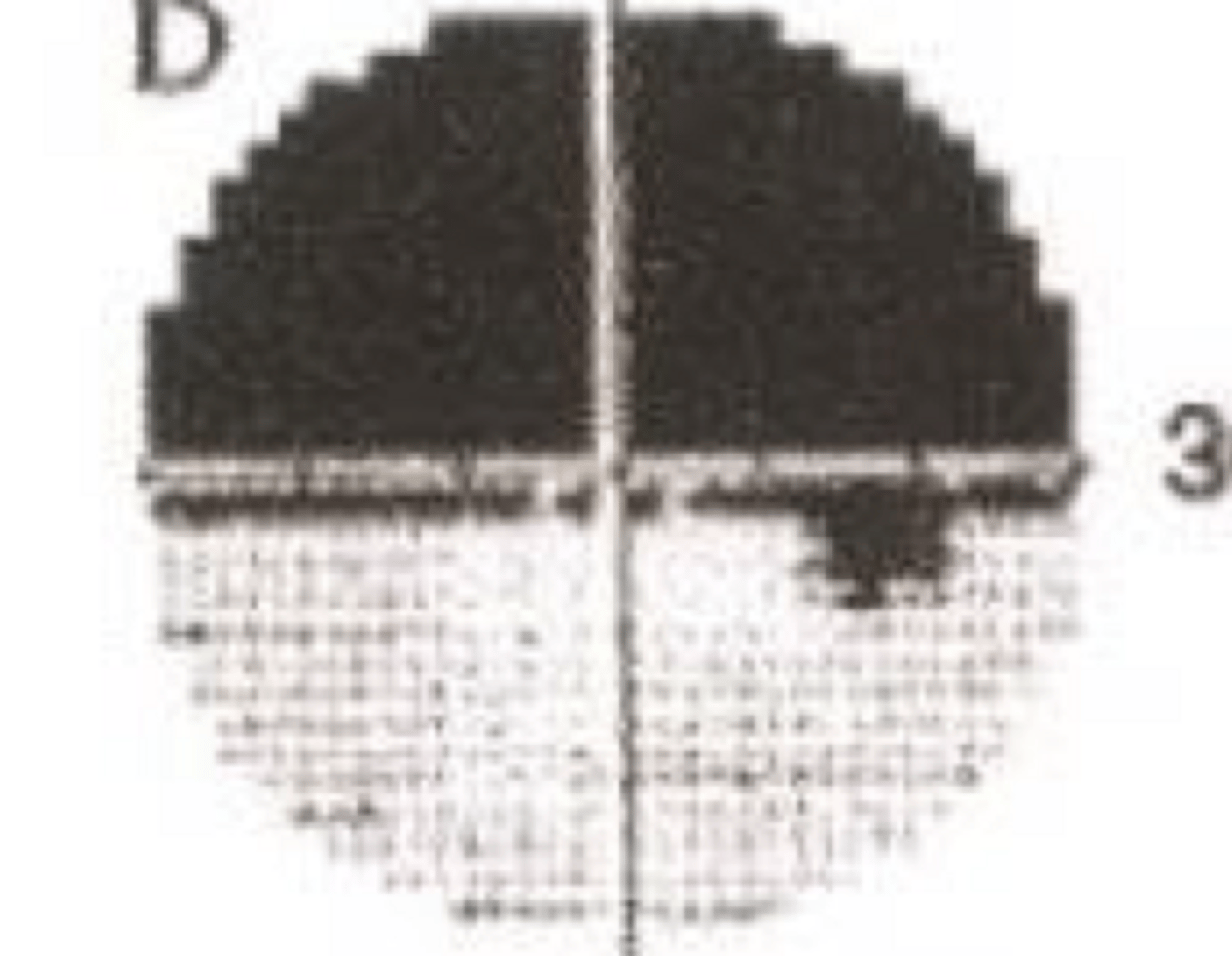 <p>What type of monocular pre-chiasmic VF defect is present in the given image?</p>