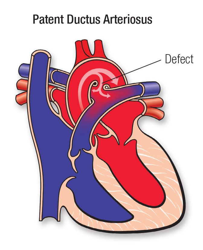 <p>Patent Ductus Arteriosus (PDA)</p>