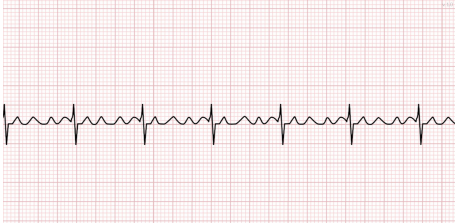 <p>What does this EKG show?</p>