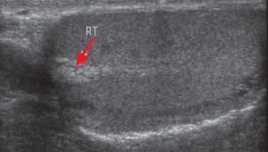 <p>What is this hypoechoic striated structure seen within the mediastinum testi?</p>