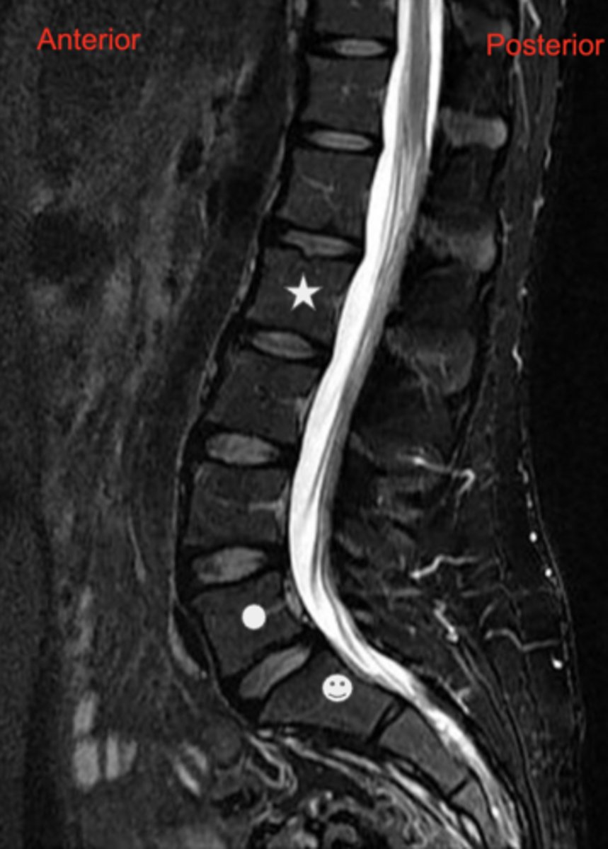 <p>answer the following about the image:</p><p>1. This MRI image was obtained with T2-weighted technique. In T2-weighted images, water that is not flowing is white. What space here is filled with relatively motionless water?</p><p>2. What features of intervertebral discs are seen?</p><p>3. What vertebra is indicated by the symbols</p>
