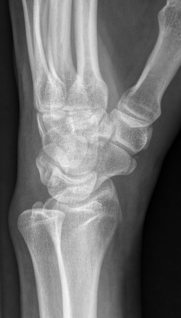<p>Describe the abnormality demonstrated.</p>