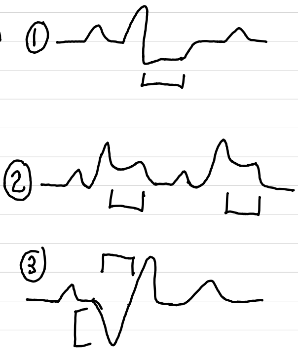 <ul><li><p>ischemia (1)</p><ul><li><p><span style="color: red;">depressed ST segment</span> (≥1 mm below baseline) or inverted T wave</p></li><li><p>injury potentially reversible</p></li></ul></li><li><p>acute myocardial injury (2)</p><ul><li><p><span style="color: red;">elevated ST segment</span></p></li><li><p>ST returns to normal with restored perfusion</p></li></ul></li><li><p>MI (3)</p><ul><li><p><span style="color: red;">elevated ST segment</span> and T wave changes in early stages</p></li><li><p>later, <span style="color: red;">pathologic Q waves</span></p><ul><li><p>appear hours to days after event</p></li><li><p>usually remain for rest of patient’s life</p></li></ul></li></ul></li></ul><p></p>