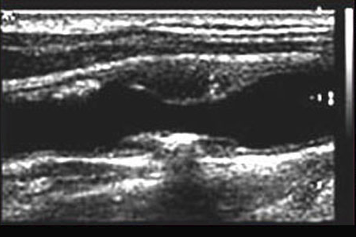 <ul><li><p>an uneven echo pattern</p></li></ul><ul><li><p>reflections of varying grayscale</p></li><li><p>not uniform in texture or composition.</p></li></ul><p></p>