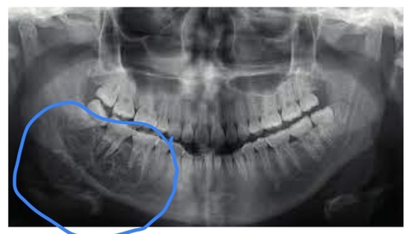 <p>A type of mesenchymal odontogenic tumour. A benign nonencapsulated infiltrating tumour. Most often occurs in young ppl age 10-29, no sex predilection. Often brought on by puberty/hormonal changes. Radiographically: multilocular, honeycombed radiolucency w/ poorly defined margins, may become large and displace teeth. Most often occurs in mand.</p>