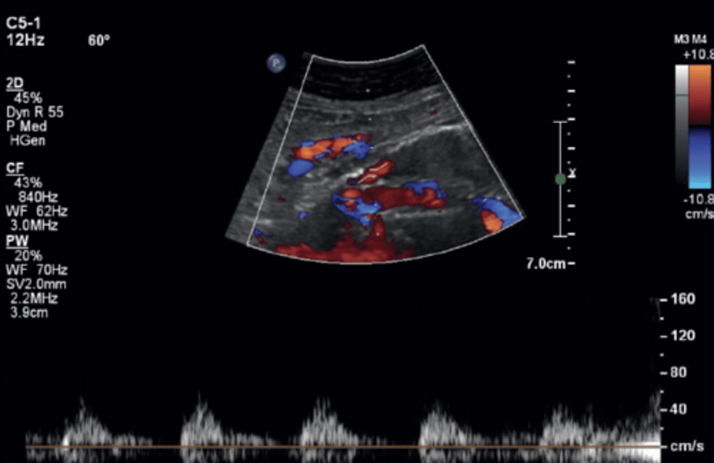 <p>Inadequate seal at attachment sites</p><p>Waveforms look like that of the graft</p><p>High flow</p>