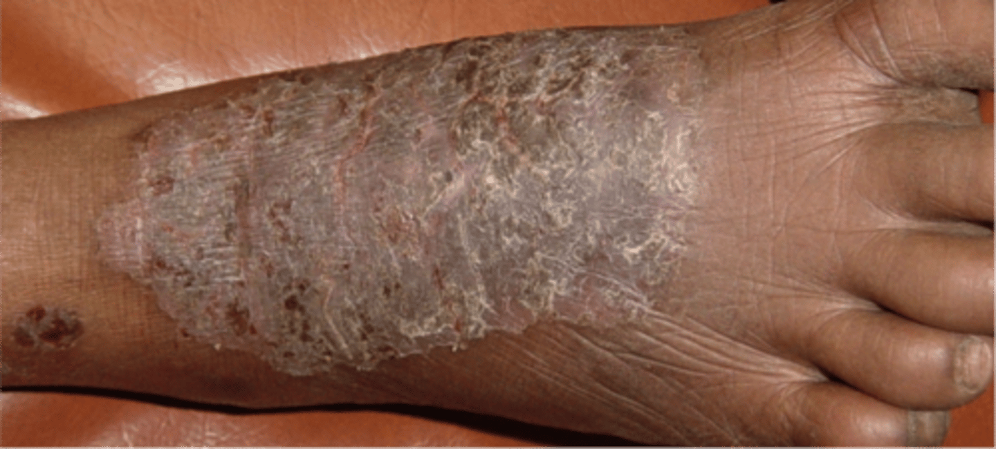<p>Lichen Simplex Chronicus</p>