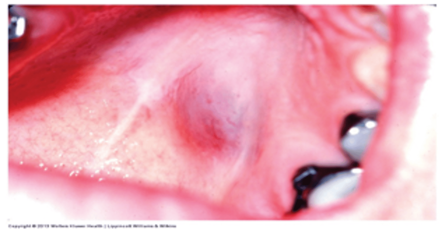 <p>MOST COMMON MALIGNANT SALIVARY GLAND TUMOR</p><p>• bluish-red asymptomatic swelling; firm or soft</p><p>• common location: palate</p>