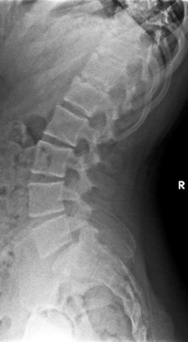 <p>Schmorl's nodes clinical significance</p>