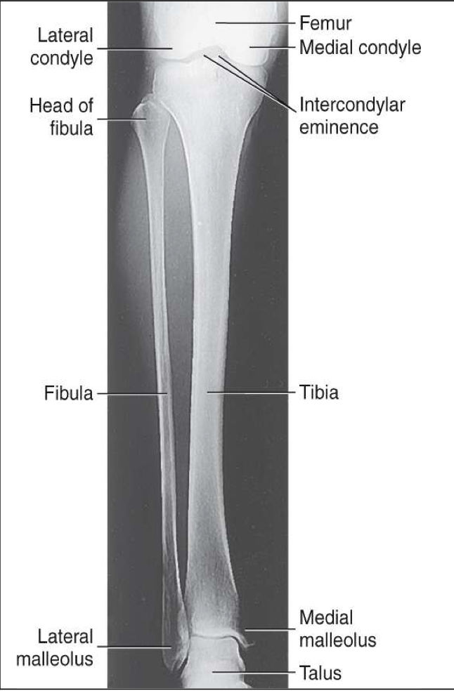 <p><span style="line-height: normal;"><span>• </span></span>Entire tibia and fibula demonstrated</p><p class="p1"><span style="line-height: normal;"><span>• </span></span>Knee and ankle joints demonstrated</p><p class="p1"><span style="line-height: normal;"><span>• </span></span>Partial superimposition of fibula and tibia at proximal and distal ends</p><ul><li><p class="p1"><span style="line-height: normal;"><span>&nbsp;</span></span>Due to divergence of the beam, neither knee nor ankle joint is fully open</p></li></ul><p class="p1"><span style="line-height: normal;"><span>• </span></span>Optimal exposure factors</p>