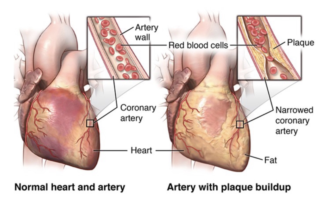 <p>-CA off the aorta, supply heart with O2/blood</p><p>-plaque builds up in the CA and disrupts blood flow, so heart has to work harder</p><p>-heart attack if tissue death</p><p>-likely if smoke, have obesity, etc.</p>