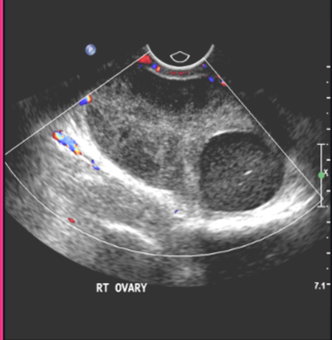 <p>What is usually the cause of ovarian torsion?</p>