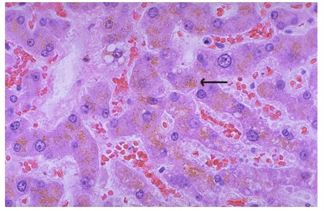 <p>Histological view of the liver with yellow-brown pigments.</p><ol><li><p>What is the yellow-brown pigment called?</p></li></ol><ol start="2"><li><p>Why does it accumulate?</p></li><li><p>What does it illustrate?</p></li></ol><p></p>