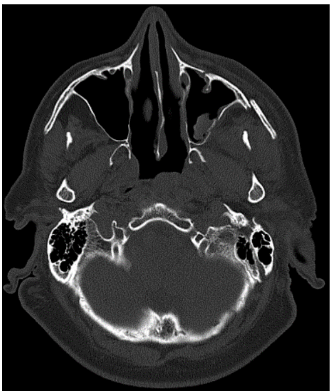 <p>What is shown in this CT bone window?</p>