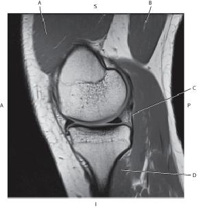 <p><span style="color: red">Which line is pointing to the popliteus muscle?</span></p>