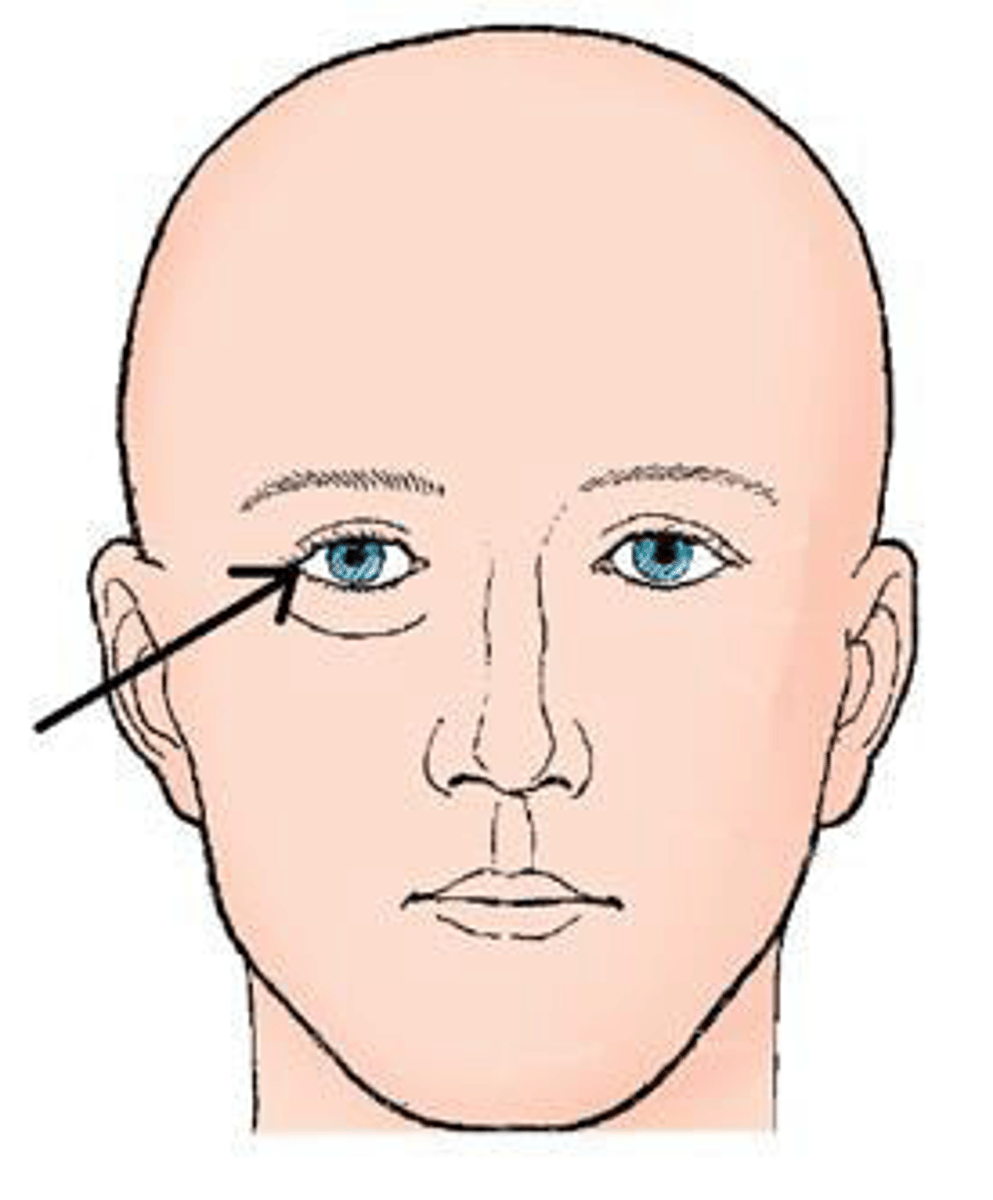 <p>c. outer canthus.</p><p>3 multiple choice options</p>