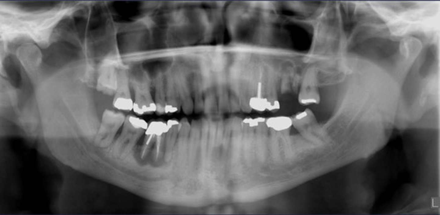 <p>what could be a differential diagnosis for this lesion? (select all that apply)</p><p>A. PCOD</p><p>B. multiple myeloma</p><p>C. apical rarefying osteitis</p><p>D. chronic sclerosing osteomyelitis</p>