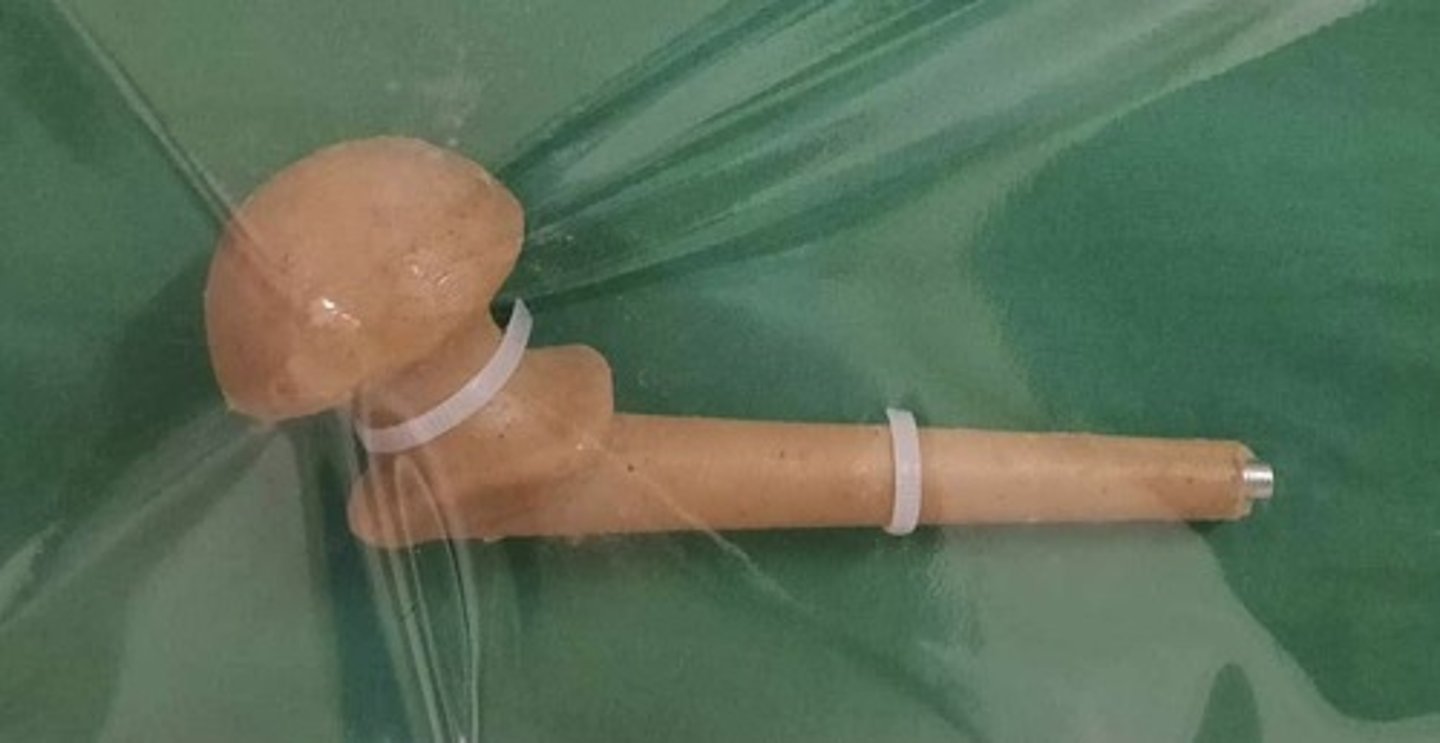 <p>Replacement of infected hip prosthesis</p>