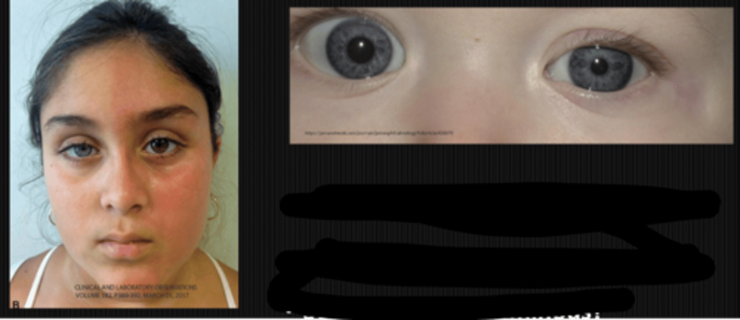 <p>younger pt</p><p>heterochromic iris = lighter iris in the Horner's eye due to reduced tyrosinase activity = reduced melanin</p><p>straighter hair on Horner's side</p><p>anyhydrosis on Horner's side</p><p>Klumpke's paralysis (spinal birth injury below C7-C8) = underdeveloped hand, paralysis, atrophy, absent triceps reflex</p>