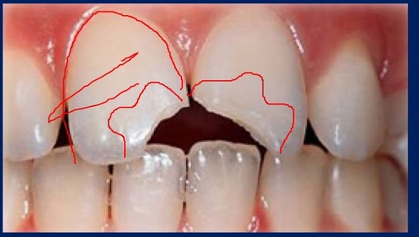 <p>If the rest of the tooth is solid, undamaged, and healthy then we may just opt to do a class 4 restoration with a long scalloped bevel rather than a full facial veneer. This would keep more natural tooth structure.</p><p>You can also palace veneers along with a tooth recontouring in the cass of say a facially tilted lateral/central incisor.</p>