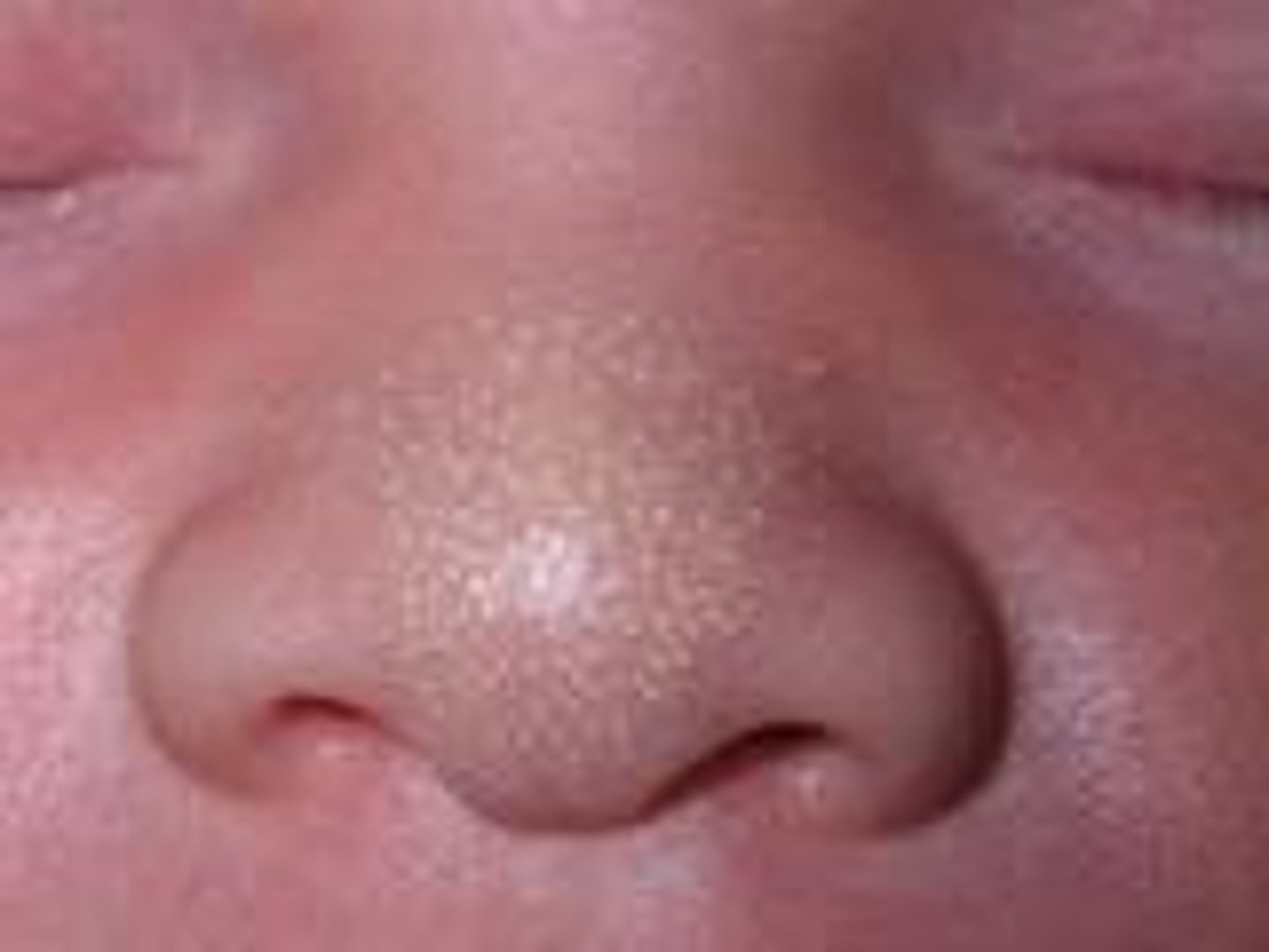 <p>A whitehead trapped under the skin; usually disappear after a few weeks</p>