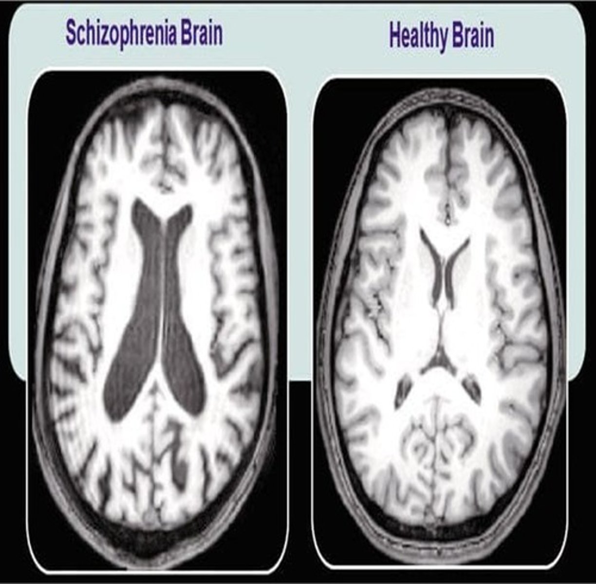 <p>the idea that schizophrenia involves an excess of dopamine activity and reduced grey matter</p>