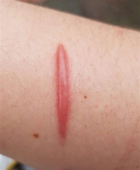 what type of scar formation is this?

