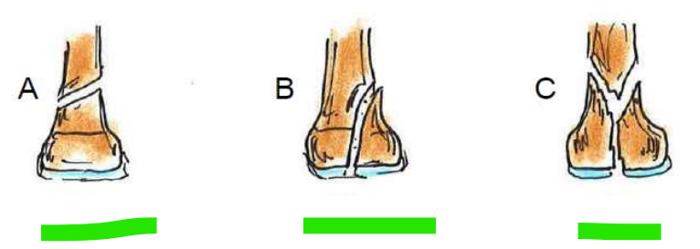 <p>Frakturtyp im Gelenkbereich</p>