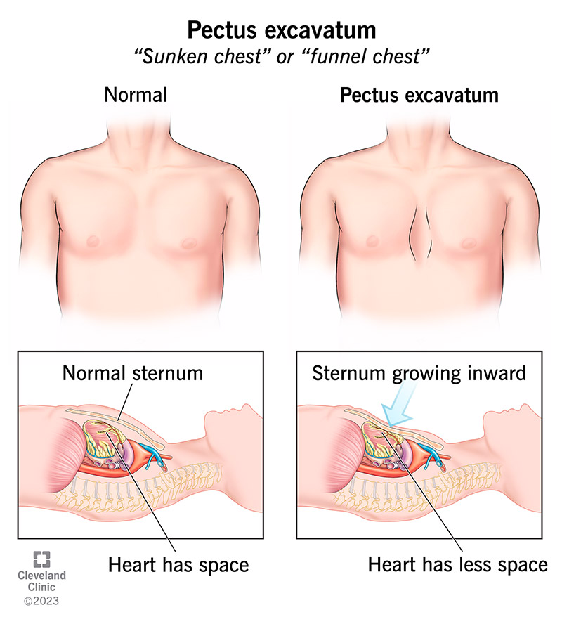 <p>depression in lower part of sternum</p><p>compressed heart+great vessels→murmur</p>